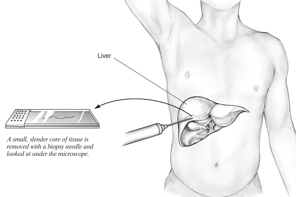 Imagen: Ilustración de biopsia hepática (Fotografía cortesía de NIH)